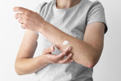 В США обновили рекомендации по лечению атопического дерматита у взрослых